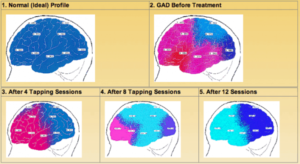 EEG brain scan after EFT