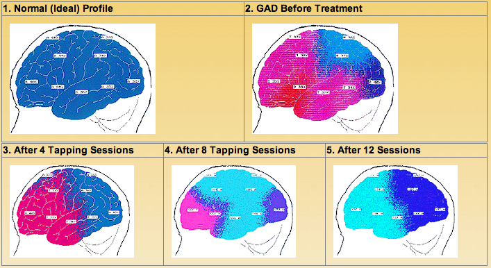 digitalized EEG brain scans